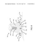 DEVICES AND SYSTEMS FOR INVERTING AND CLOSING THE LEFT ATRIAL APPENDAGE diagram and image