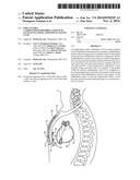 IMPLANTABLE CARDIOVERTER-DEFIBRILLATOR (ICD) SYSTEM INCLUDING SUBSTERNAL     PACING LEAD diagram and image