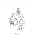 IMPLANTABLE CARDIOVERTER-DEFIBRILLATOR (ICD) SYSTEM INCLUDING SUBSTERNAL     PACING LEAD diagram and image