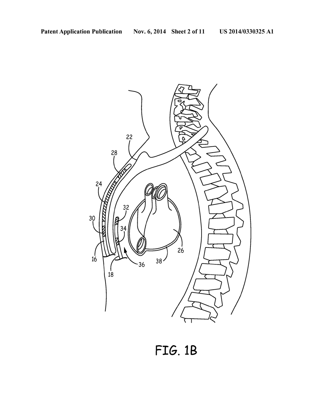 IMPLANTABLE CARDIOVERTER-DEFIBRILLATOR (ICD) SYSTEM INCLUDING SUBSTERNAL     PACING LEAD - diagram, schematic, and image 03