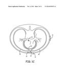 IMPLANTABLE CARDIOVERTER-DEFIBRILLATOR (ICD) SYSTEM INCLUDING SUBSTERNAL     PACING LEAD diagram and image