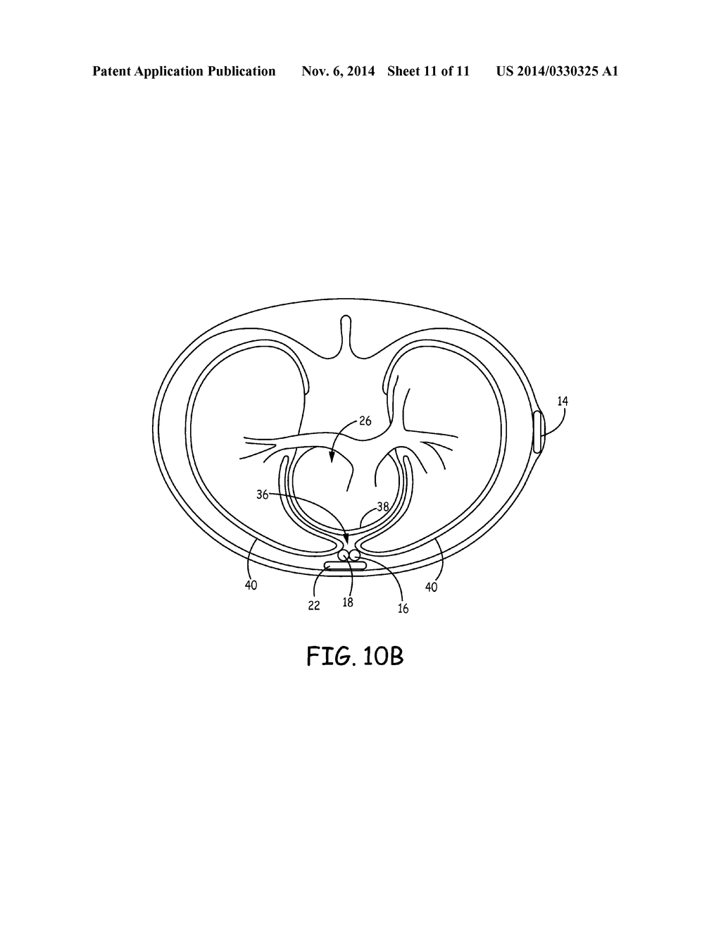 IMPLANTABLE CARDIOVERTER-DEFIBRILLATOR (ICD) SYSTEM INCLUDING SUBSTERNAL     PACING LEAD - diagram, schematic, and image 12