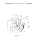 SUBSTERNAL ELECTRICAL STIMULATION SYSTEM diagram and image