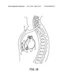 SUBSTERNAL ELECTRICAL STIMULATION SYSTEM diagram and image