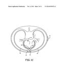 SUBSTERNAL ELECTRICAL STIMULATION SYSTEM diagram and image