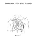 SUBSTERNAL ELECTRICAL STIMULATION SYSTEM diagram and image