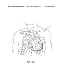 SUBSTERNAL ELECTRICAL STIMULATION SYSTEM diagram and image