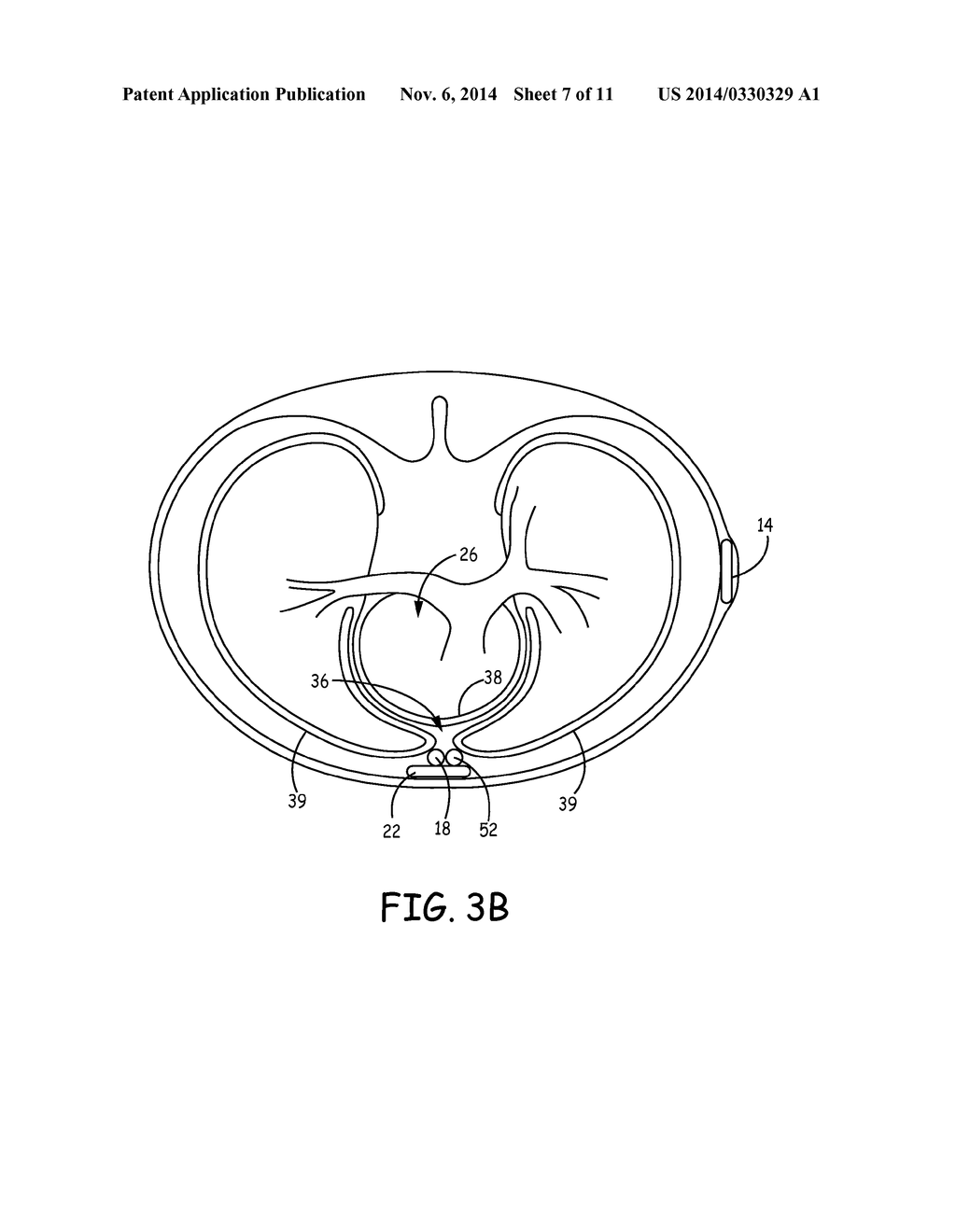 SUBSTERNAL ELECTRICAL STIMULATION SYSTEM - diagram, schematic, and image 08