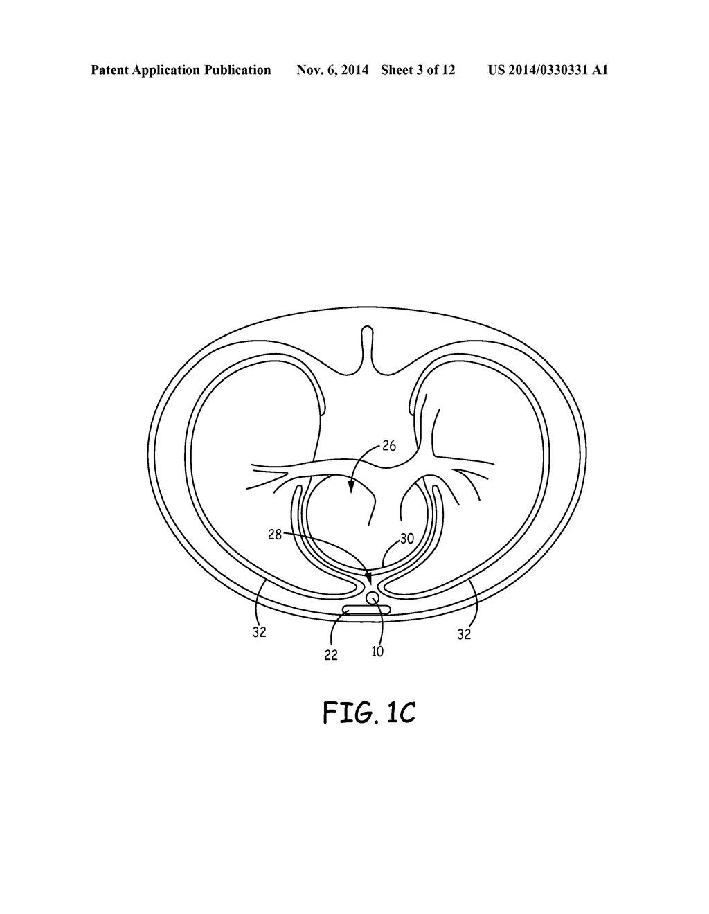 SUBSTERNAL LEADLESS ELECTRICAL STIMULATION SYSTEM - diagram, schematic, and image 04