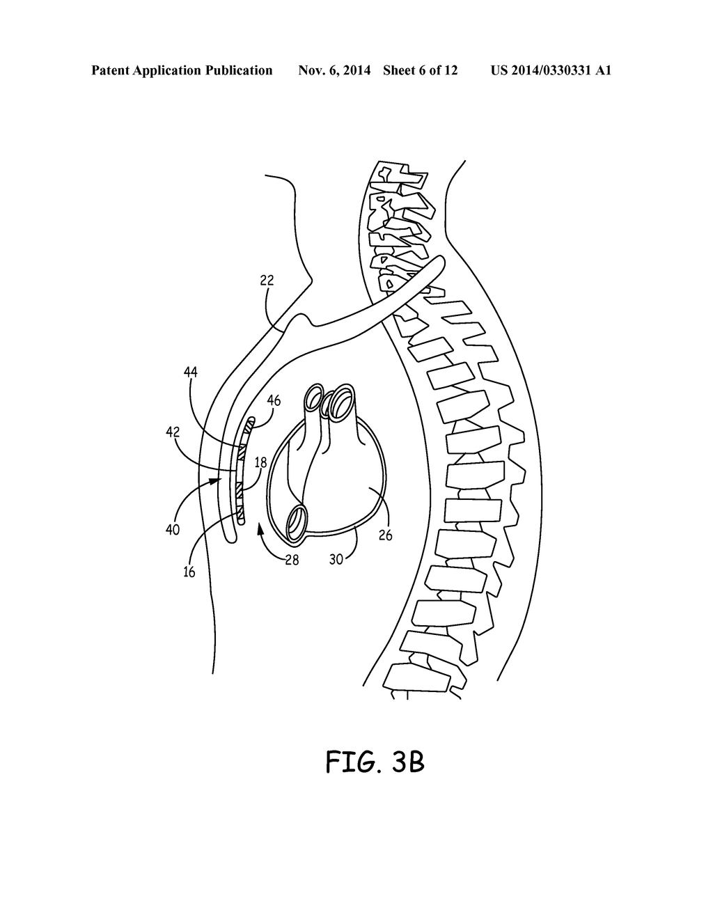 SUBSTERNAL LEADLESS ELECTRICAL STIMULATION SYSTEM - diagram, schematic, and image 07