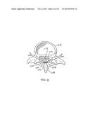 APPARATUS AND METHOD USING NEAR INFRARED REFLECTOMETRY TO REDUCE THE     EFFECT OF POSITIONAL CHANGES DURING SPINAL CORD STIMULATION diagram and image