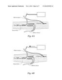 SYSTEMS AND METHODS FOR THE TREATMENT OF PAIN THROUGH NEURAL FIBER     STIMULATION diagram and image