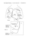 INDEPENDENTLY ACTUATABLE SWITCH FOR SELECTION OF AN MRI COMPATIBLE     BANDSTOP FILTER PLACED IN SERIES WITH A PARTICULAR THERAPY ELECTRODE OF     AN ACTIVE IMPLANTABLE MEDICAL DEVICE diagram and image