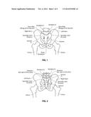 ARTIFICIAL SI JOINT diagram and image