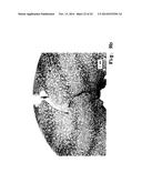 Osteosynthesis with nano-silver diagram and image