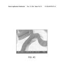 Polymer Blends For Drug Delivery Stent Matrix With Improved Thermal     Stability diagram and image