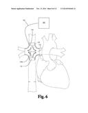 CAVOPULMONARY VISCOUS IMPELLER ASSIST DEVICE AND METHOD diagram and image