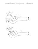 POSITIONING APPARATUS AND METHOD FOR A PROSTHETIC IMPLANT diagram and image