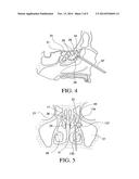 BALLOON CATHETERS AND METHODS FOR TREATING PARANASAL SINUSES diagram and image