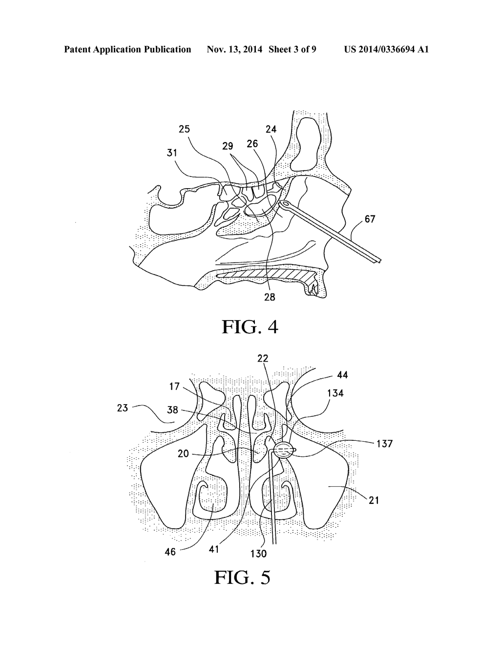 BALLOON CATHETERS AND METHODS FOR TREATING PARANASAL SINUSES - diagram, schematic, and image 04