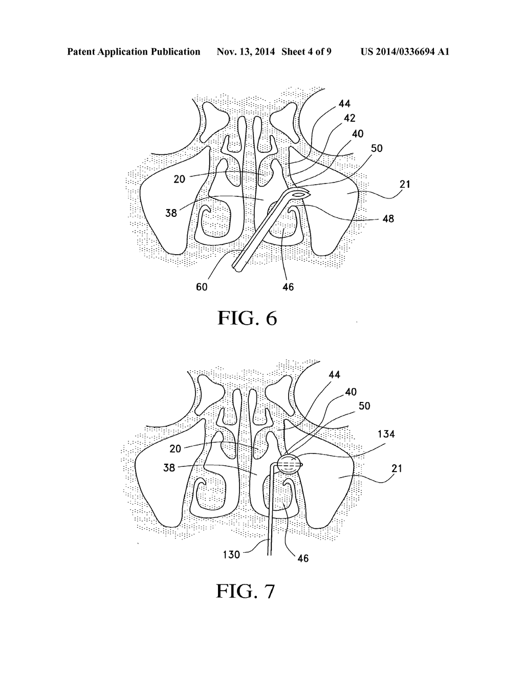 BALLOON CATHETERS AND METHODS FOR TREATING PARANASAL SINUSES - diagram, schematic, and image 05