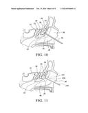 BALLOON CATHETERS AND METHODS FOR TREATING PARANASAL SINUSES diagram and image