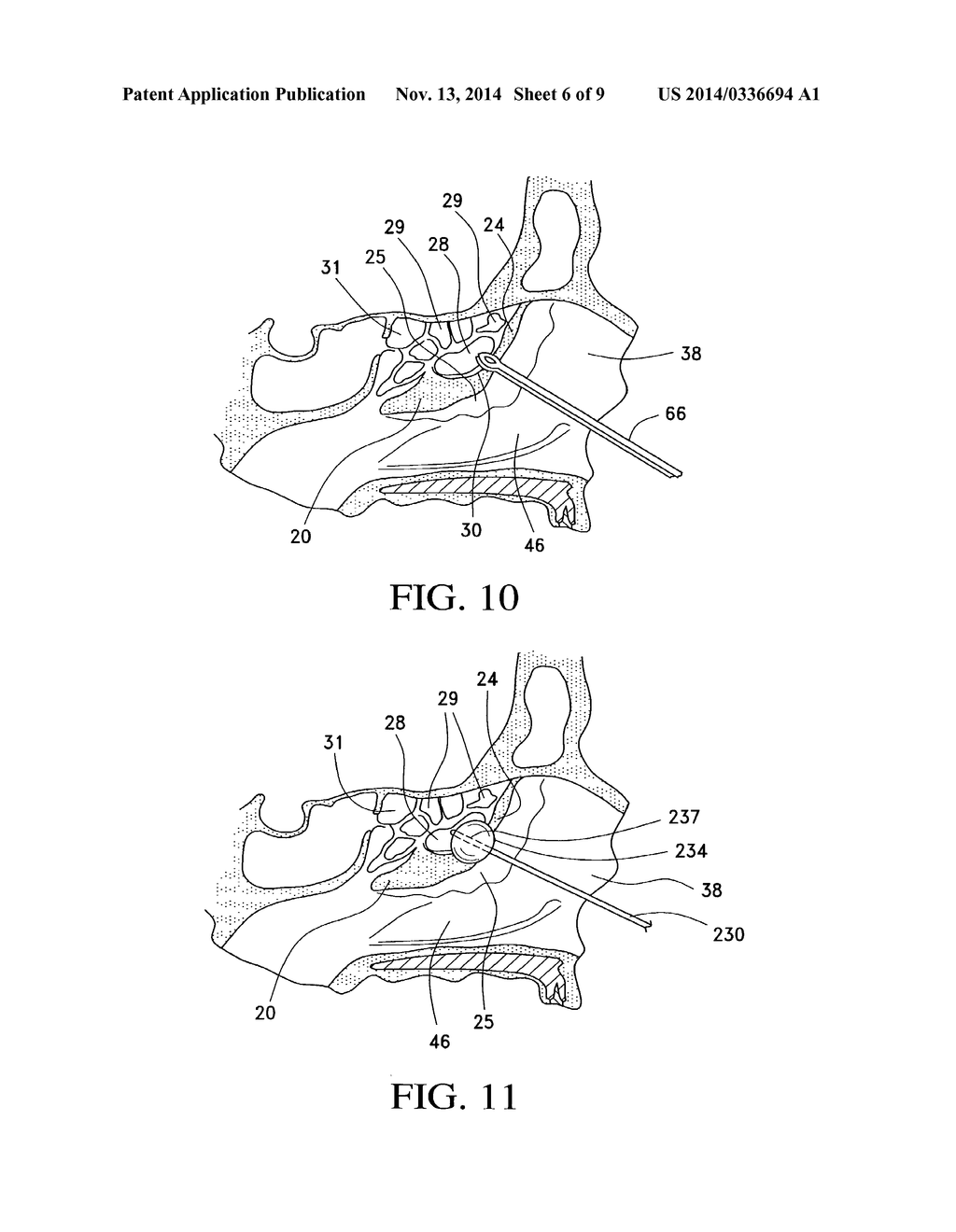 BALLOON CATHETERS AND METHODS FOR TREATING PARANASAL SINUSES - diagram, schematic, and image 07