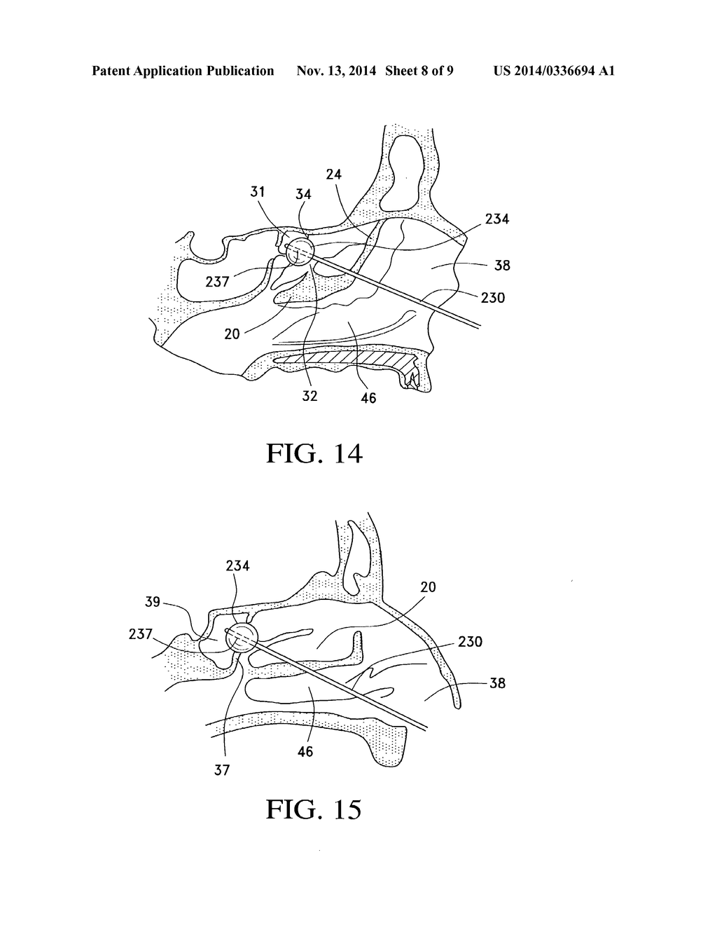 BALLOON CATHETERS AND METHODS FOR TREATING PARANASAL SINUSES - diagram, schematic, and image 09