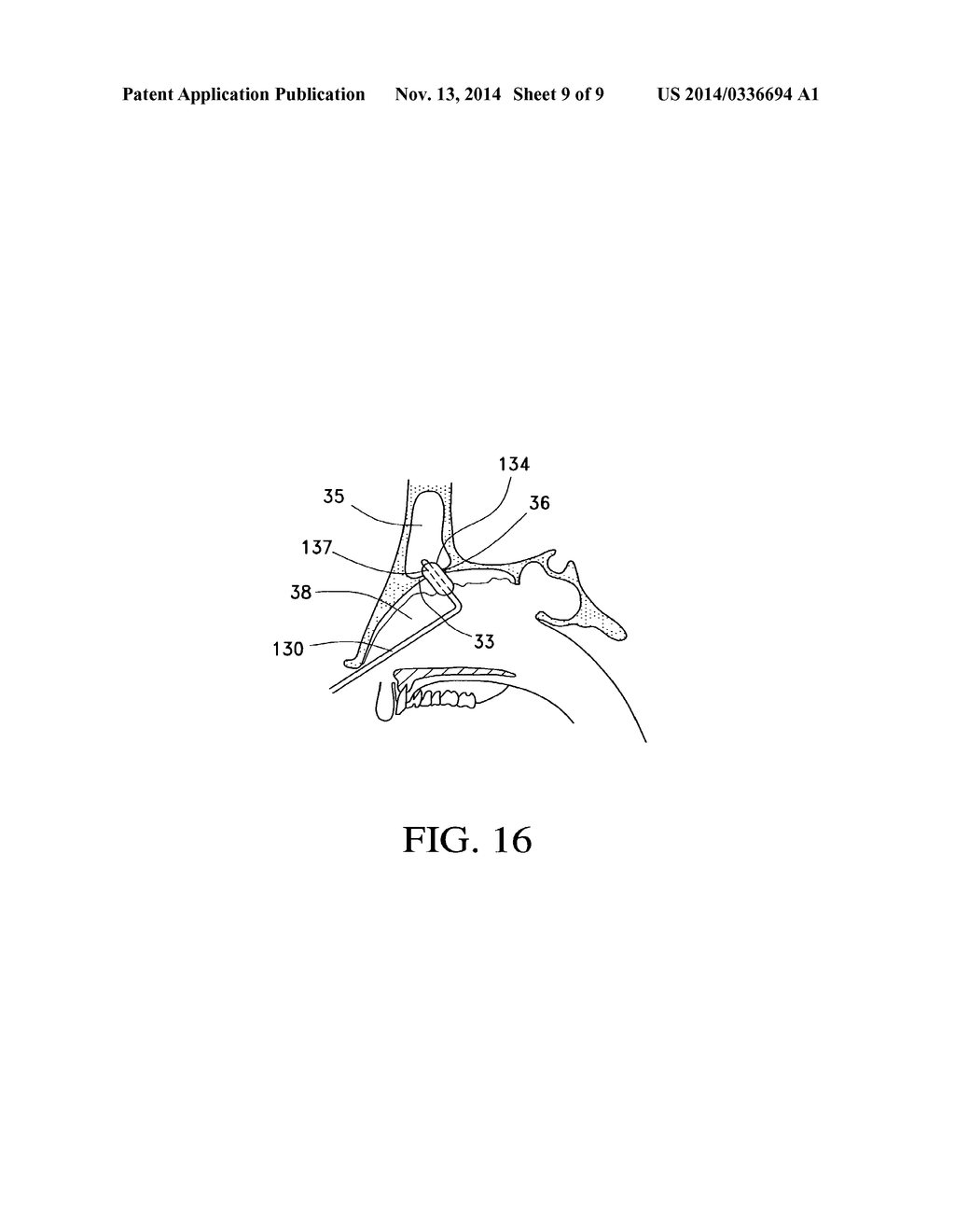 BALLOON CATHETERS AND METHODS FOR TREATING PARANASAL SINUSES - diagram, schematic, and image 10
