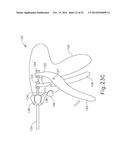 SURGICAL INSTRUMENT WITH SPLIT JAW diagram and image