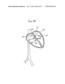 EXPANDABLE CLIP FOR TISSUE REPAIR diagram and image