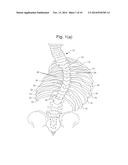 SEGMENTAL ORTHOPEDIC DEVICE FOR SPINAL ELONGATION AND FOR TREATMENT OF     SCOLIOSIS diagram and image