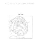 SEGMENTAL ORTHOPEDIC DEVICE FOR SPINAL ELONGATION AND FOR TREATMENT OF     SCOLIOSIS diagram and image