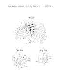 SEGMENTAL ORTHOPEDIC DEVICE FOR SPINAL ELONGATION AND FOR TREATMENT OF     SCOLIOSIS diagram and image