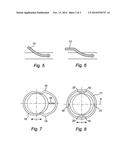 Accommodating Intraocular Lens with Haptics for Sulcus Fixation diagram and image