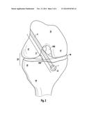 DEVICE FOR IMPLANTING A SYSTEM FOR LOADING A CRUCIATE LIGAMENT IN A KNEE     JOINT diagram and image