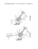 SYSTEMS FOR AND METHODS OF FUSING A SACROILIAC JOINT diagram and image