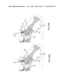 SYSTEMS FOR AND METHODS OF FUSING A SACROILIAC JOINT diagram and image