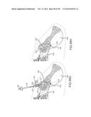 SYSTEMS FOR AND METHODS OF FUSING A SACROILIAC JOINT diagram and image