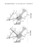 SYSTEMS FOR AND METHODS OF FUSING A SACROILIAC JOINT diagram and image