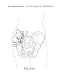 SYSTEMS FOR AND METHODS OF FUSING A SACROILIAC JOINT diagram and image