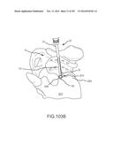 SYSTEMS FOR AND METHODS OF FUSING A SACROILIAC JOINT diagram and image