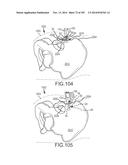 SYSTEMS FOR AND METHODS OF FUSING A SACROILIAC JOINT diagram and image