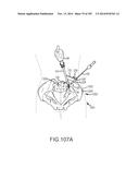 SYSTEMS FOR AND METHODS OF FUSING A SACROILIAC JOINT diagram and image