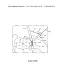 SYSTEMS FOR AND METHODS OF FUSING A SACROILIAC JOINT diagram and image