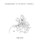 SYSTEMS FOR AND METHODS OF FUSING A SACROILIAC JOINT diagram and image