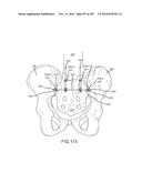 SYSTEMS FOR AND METHODS OF FUSING A SACROILIAC JOINT diagram and image