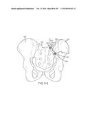 SYSTEMS FOR AND METHODS OF FUSING A SACROILIAC JOINT diagram and image