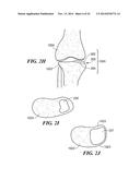 Patient Selectable Knee Arthroplasty Devices diagram and image