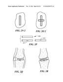 Patient Selectable Knee Arthroplasty Devices diagram and image